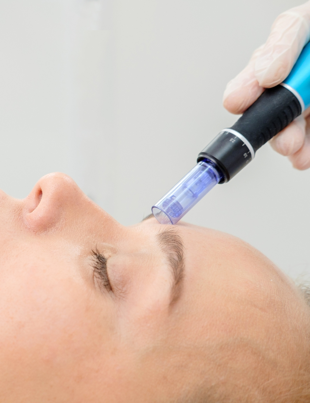 Microneedling-behandling hos Klinikk Lumena
