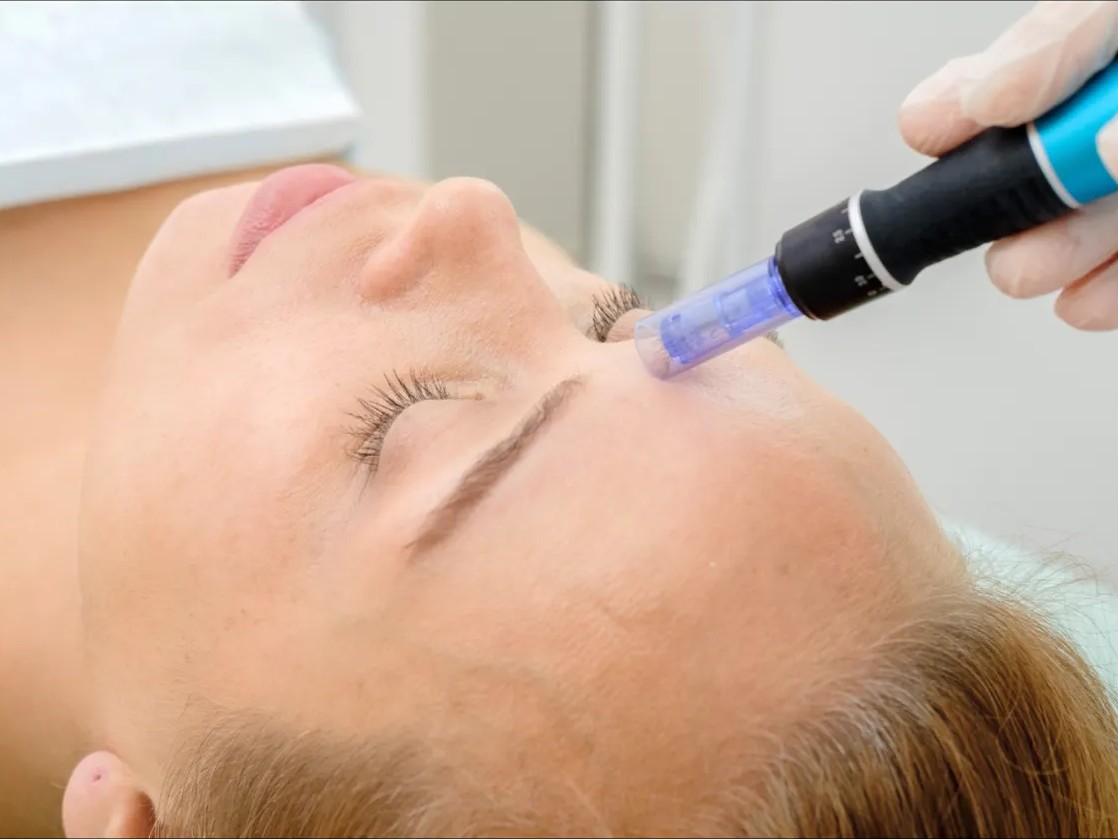Microneedling hos Klinikk Lumena
