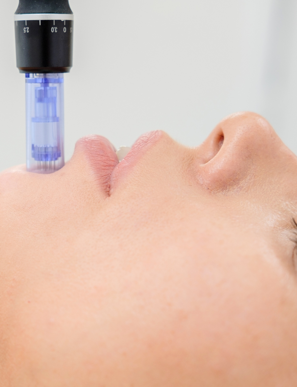 Microneedling av panne og kinn